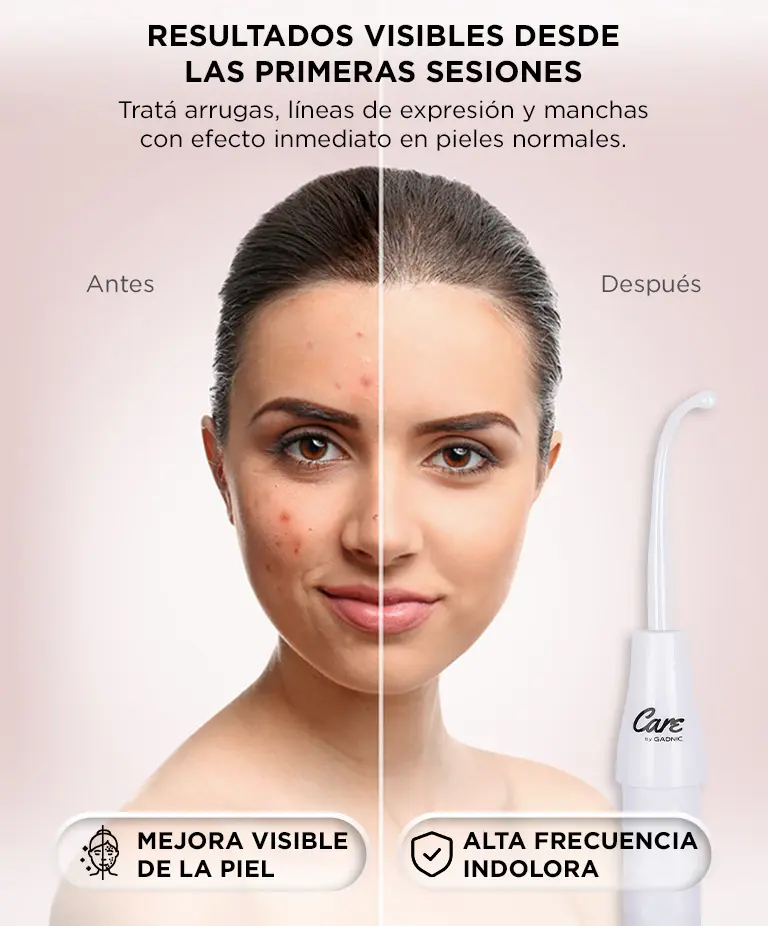 Equipo de Alta Frecuencia Gadnic LF60 Antienvejecimiento Antiacné Reafirmante Facial 4 Electrodos — imagen 4